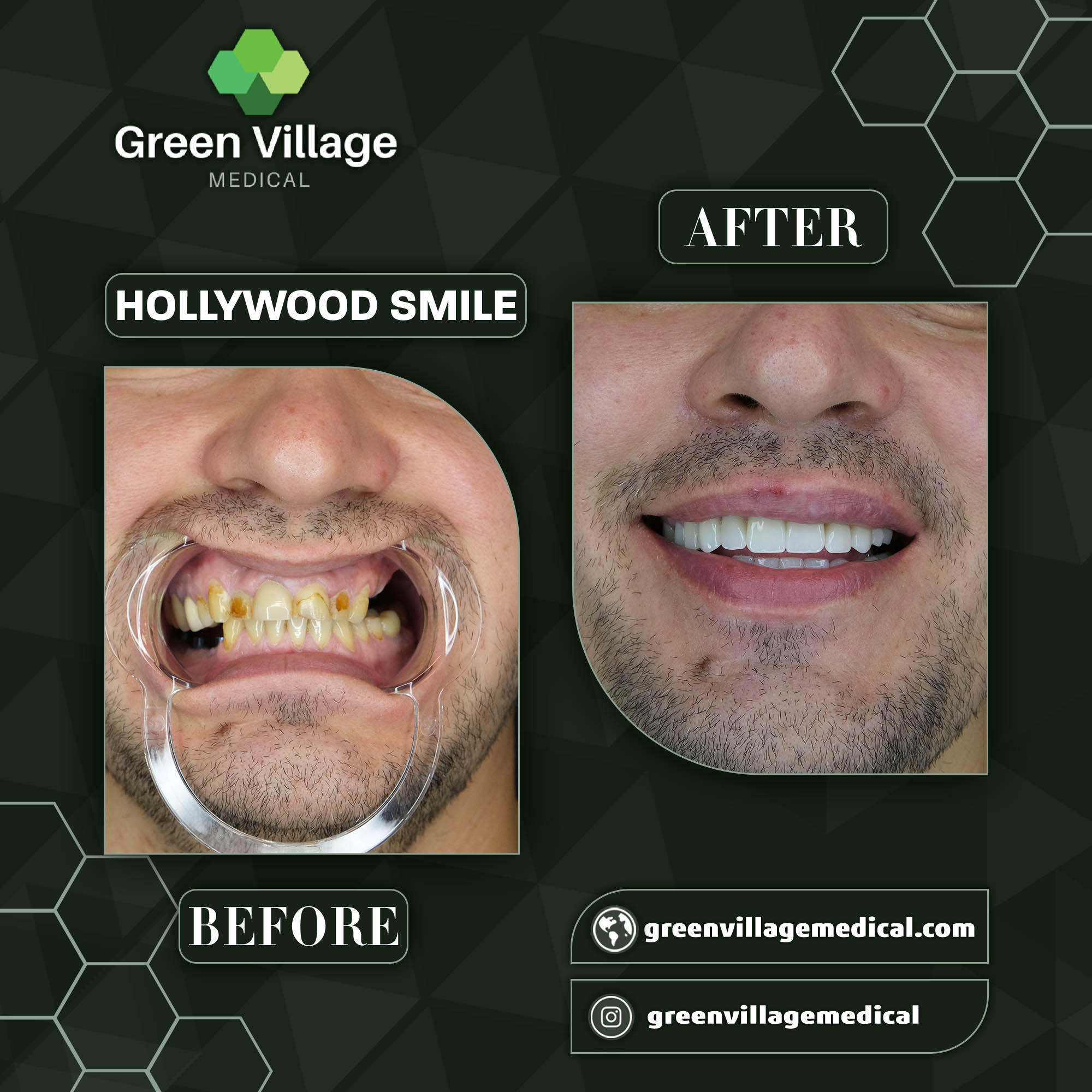 Hollywood Smile 1