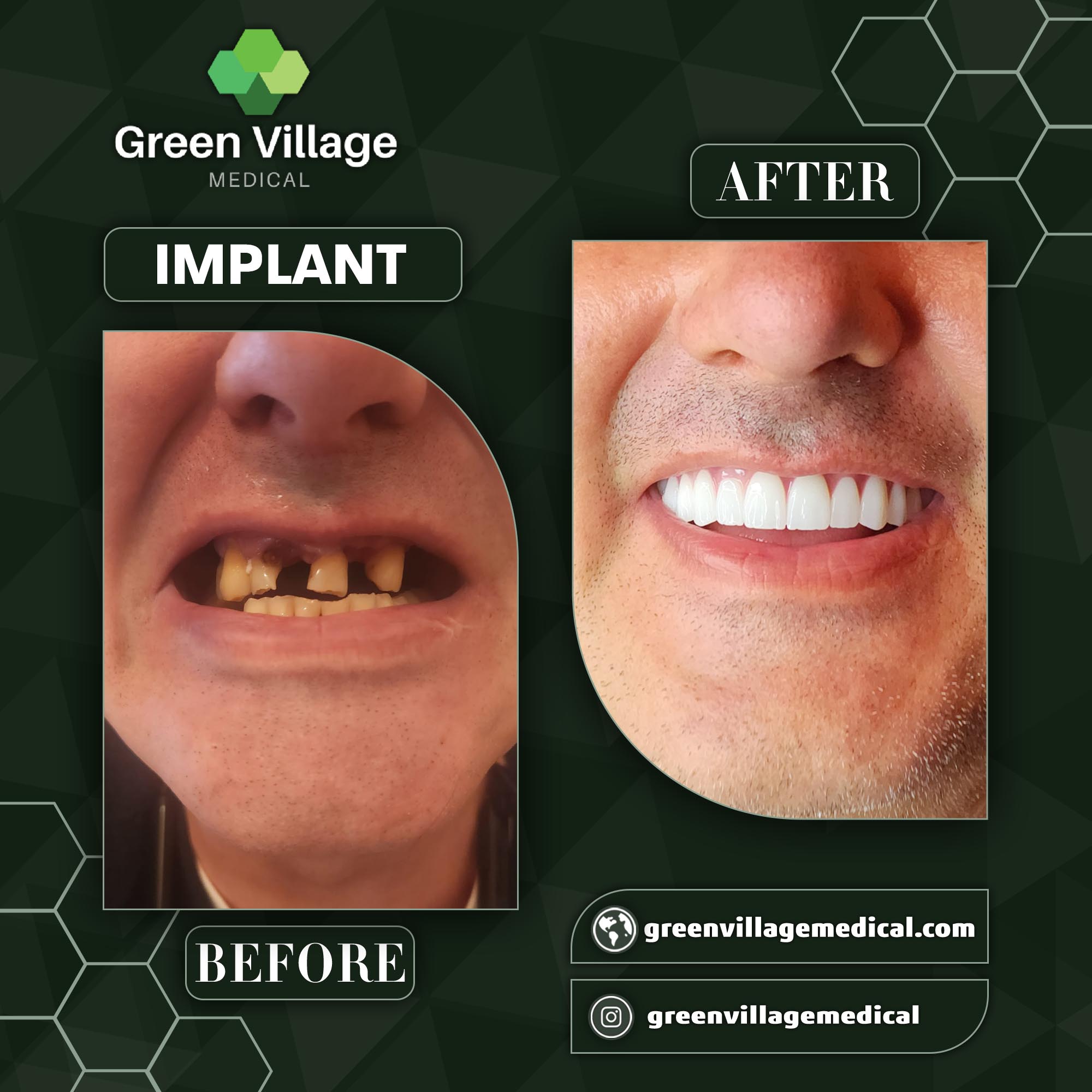 Implant 1
