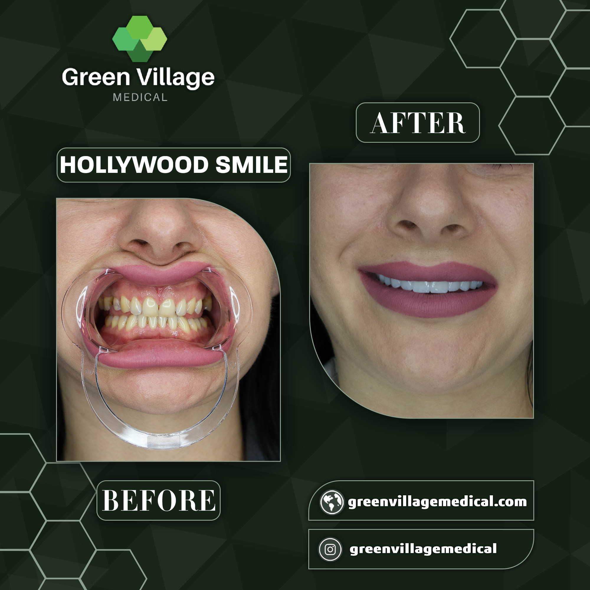 Hollywood Smile 2