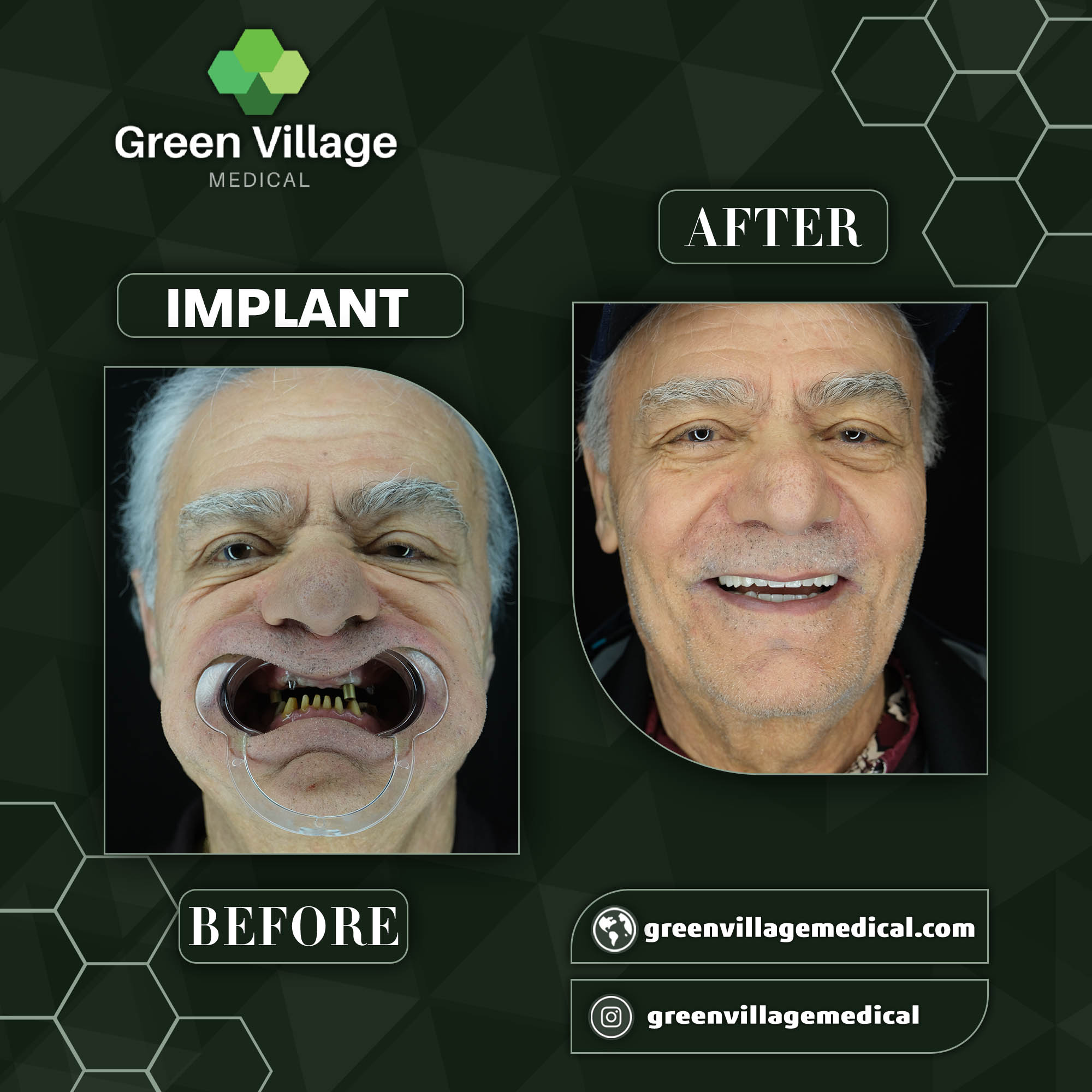 Implant 3