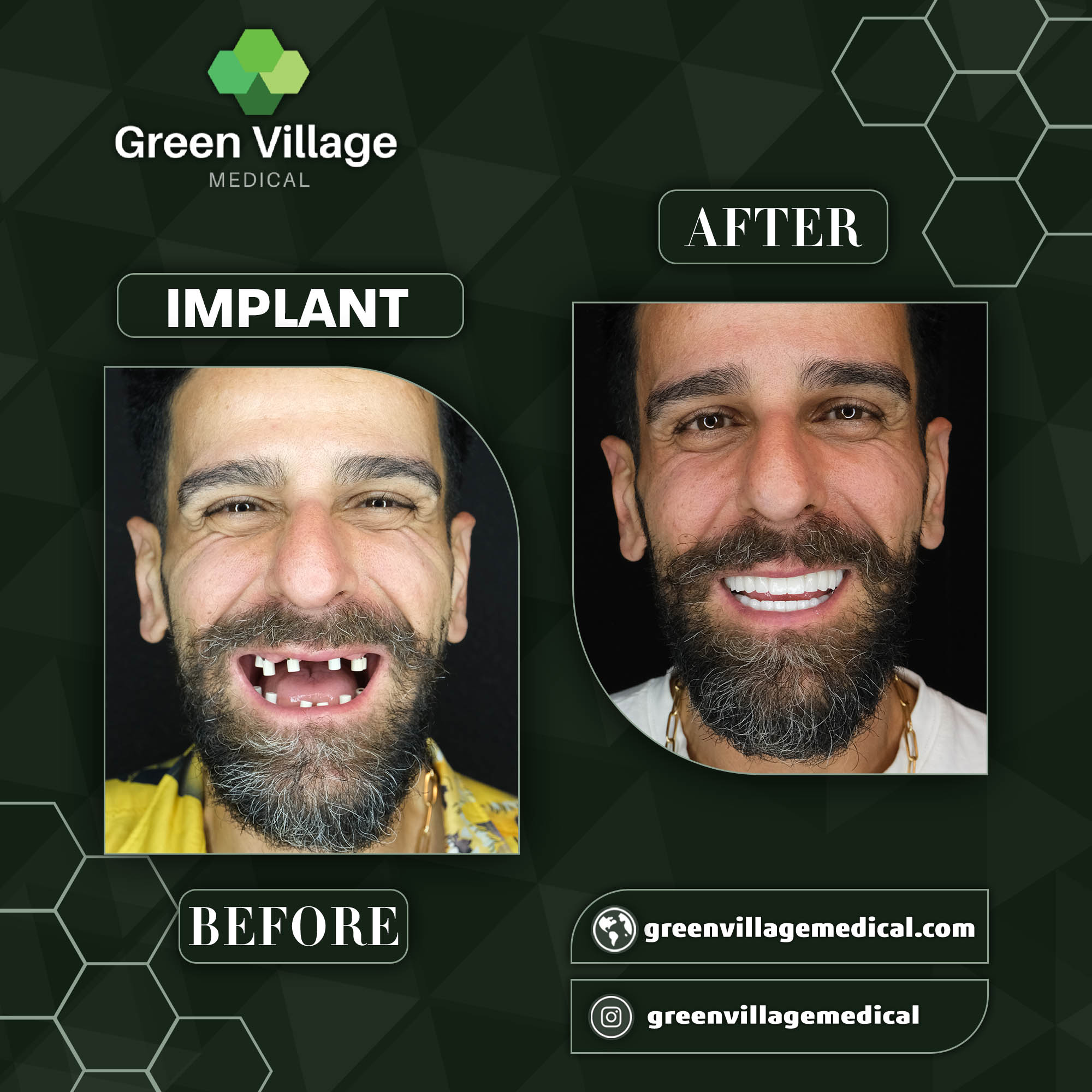 Implant 4