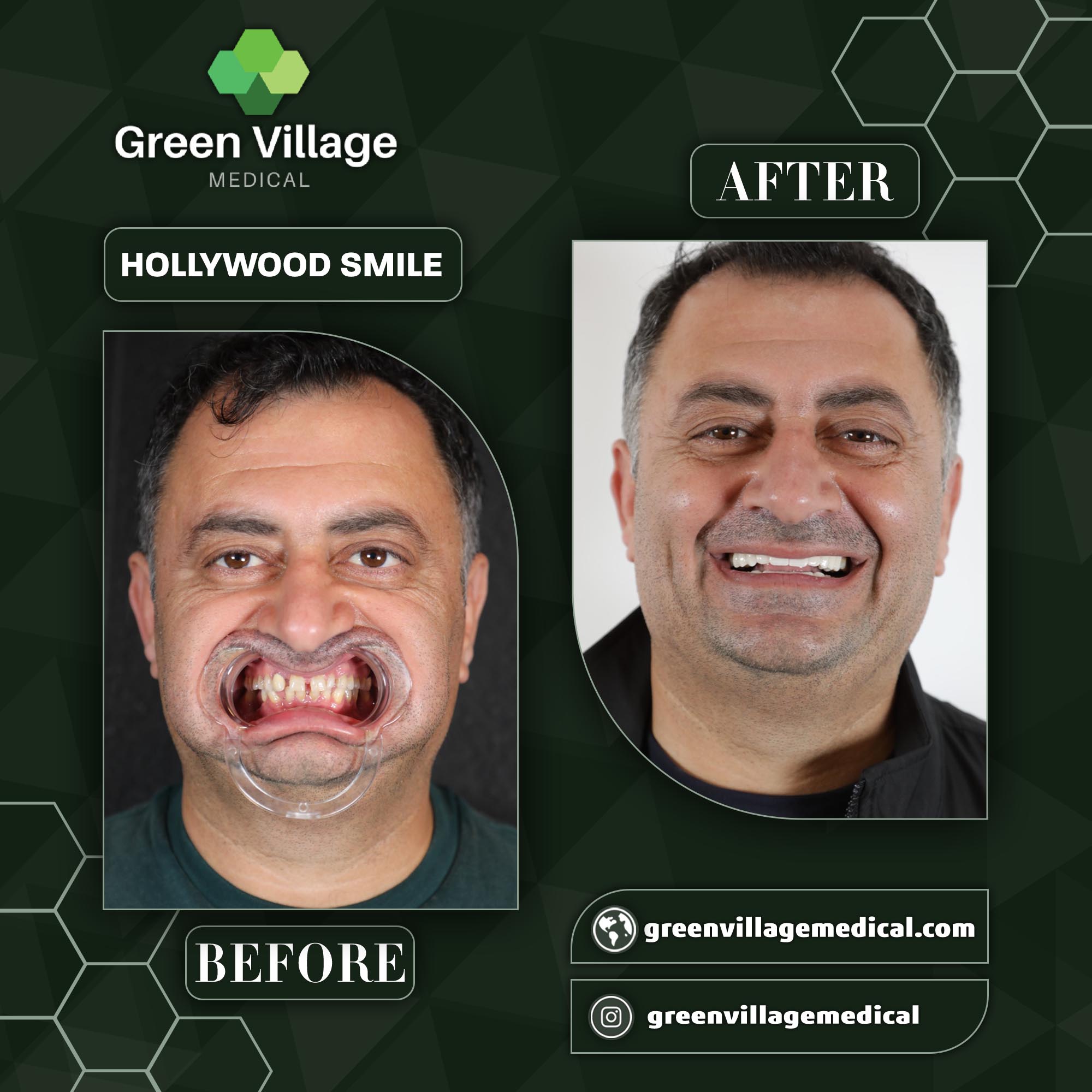 Hollywood Smile case