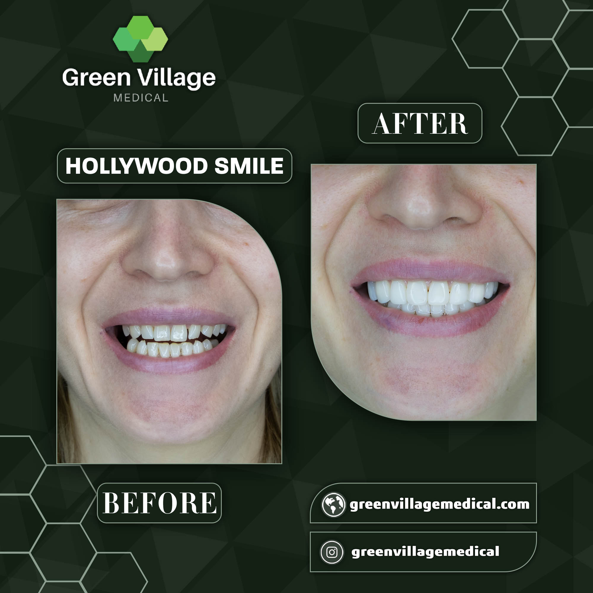 Hollywood Smile 4