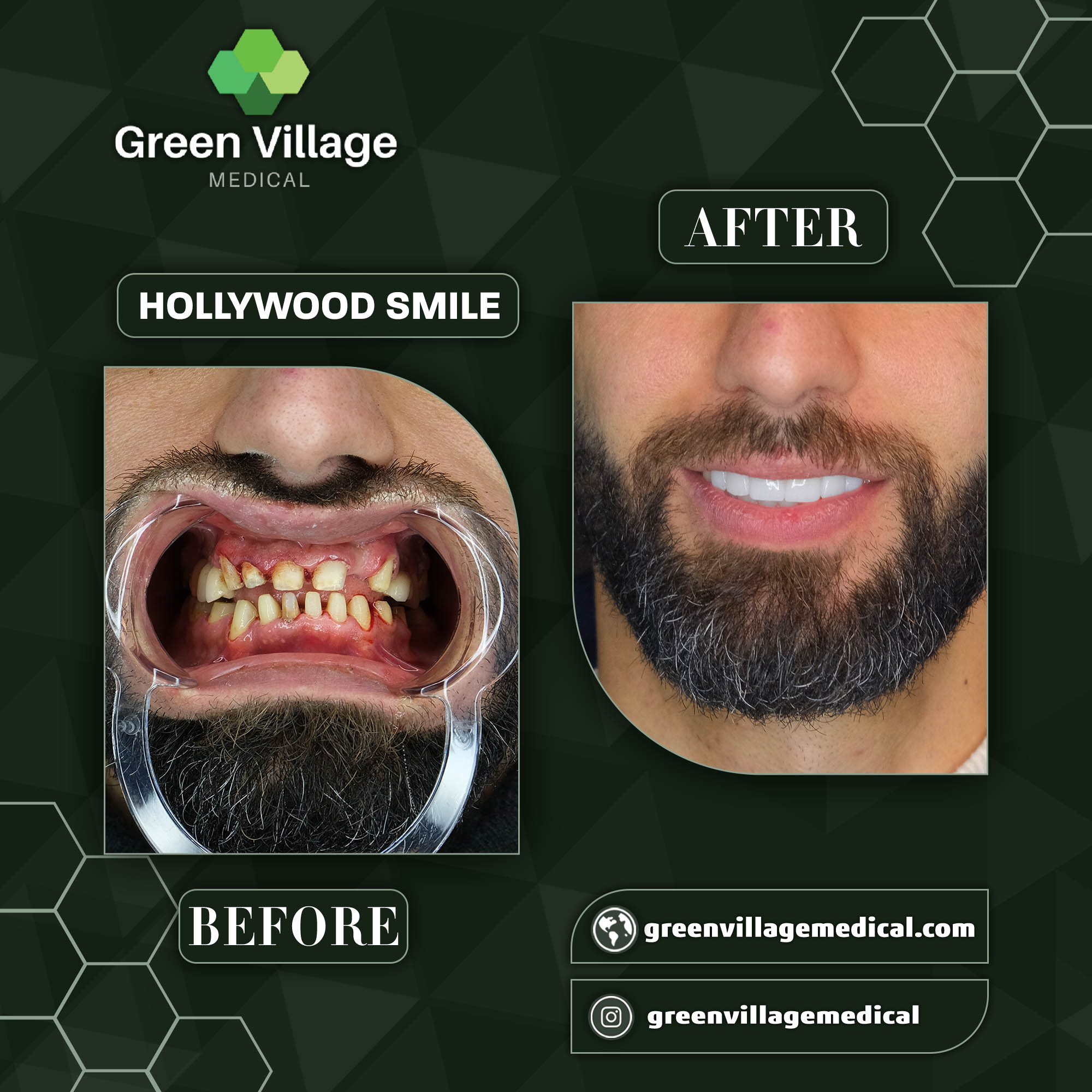 Hollywood Smile 5