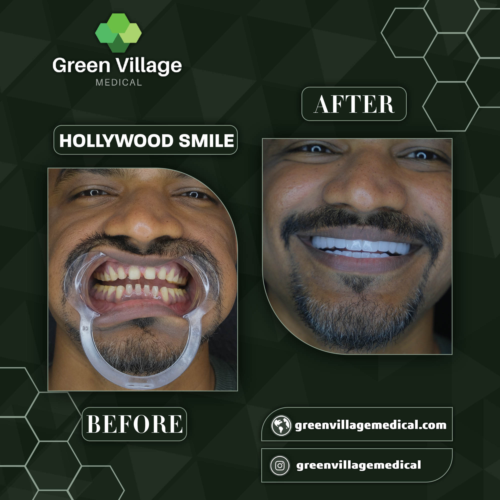 Hollywood Smile 7