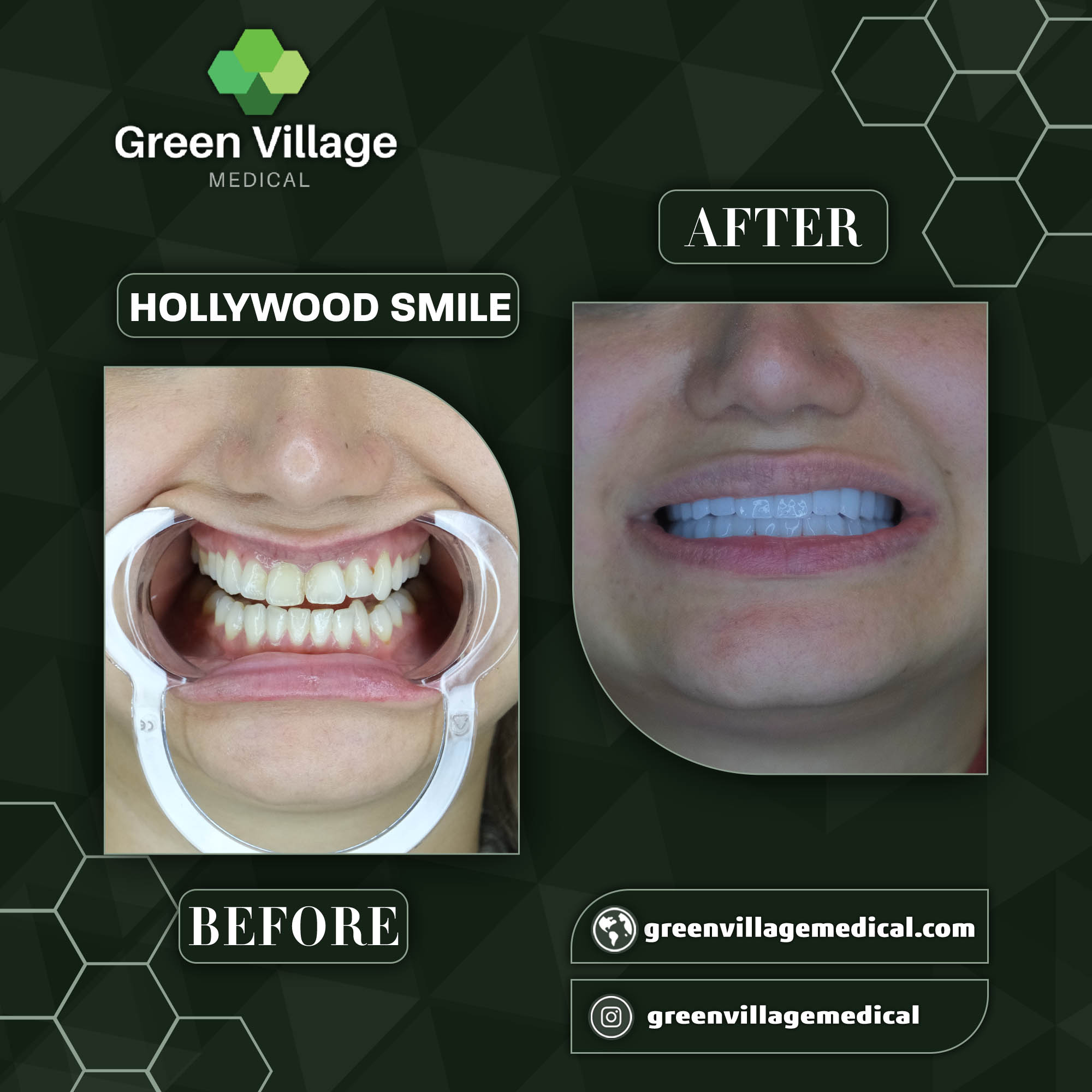 Hollywood Smile 8