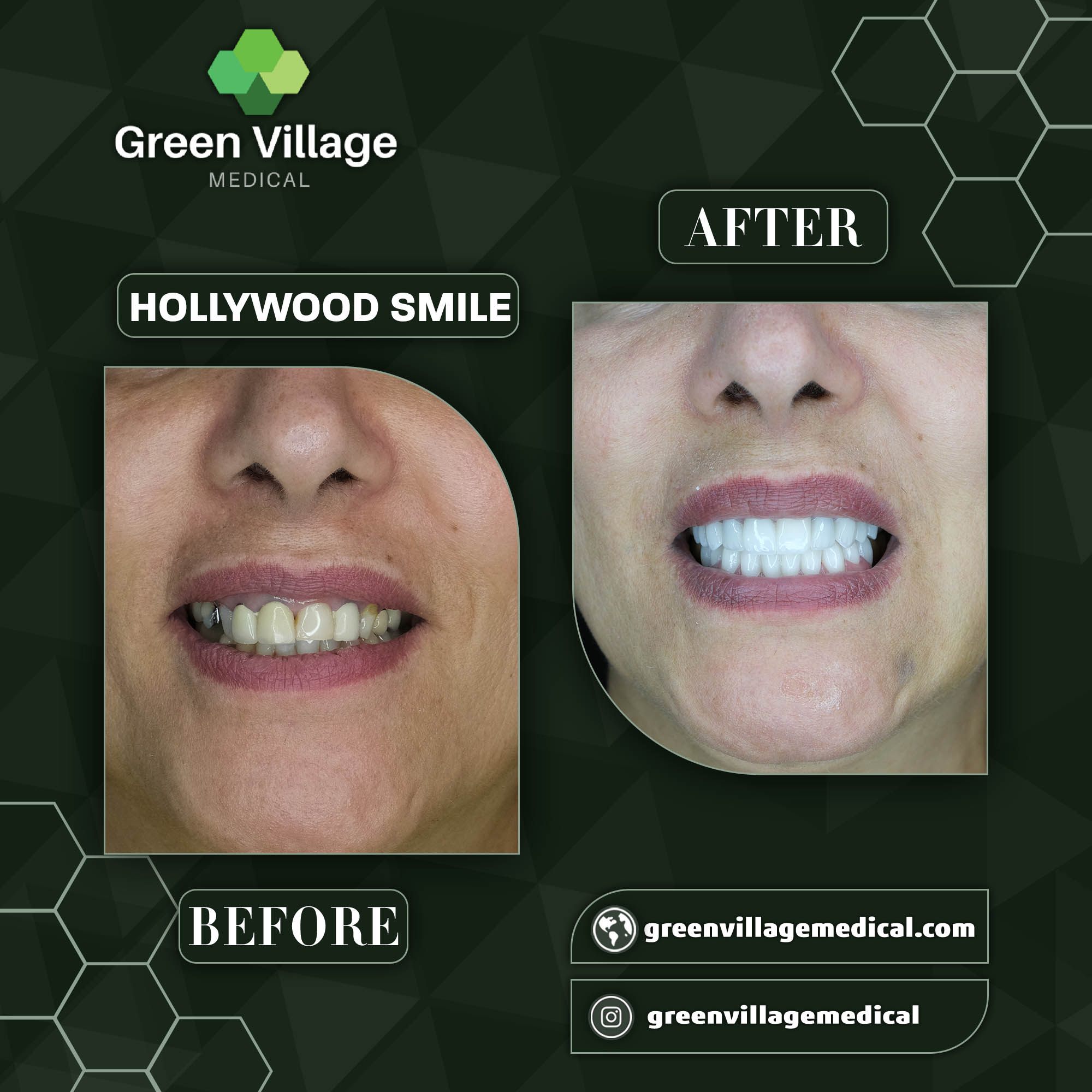 Hollywood Smile 9